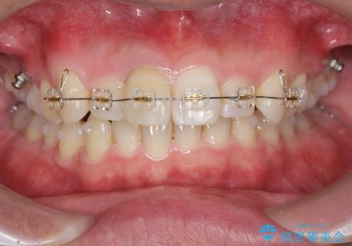 2級ディープバイト 遠心移動を伴うマウスピース矯正の治療中