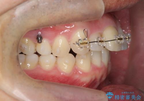 2級ディープバイト 遠心移動を伴うマウスピース矯正の治療中