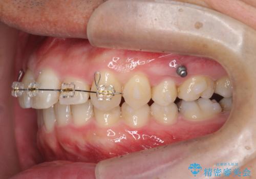 2級ディープバイト 遠心移動を伴うマウスピース矯正の治療中