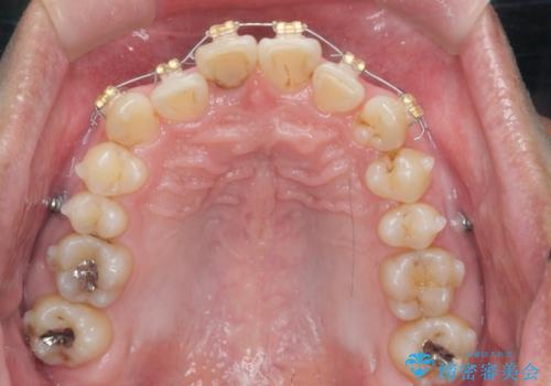 2級ディープバイト 遠心移動を伴うマウスピース矯正の治療中