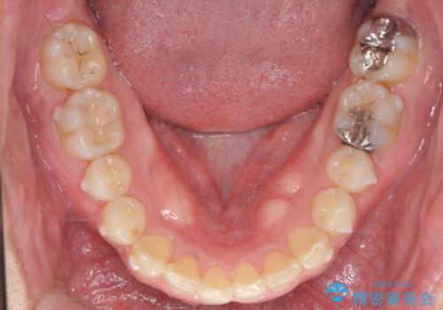 2級ディープバイト 遠心移動を伴うマウスピース矯正の治療中
