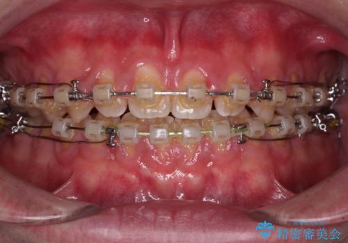 空隙歯列を閉じる 舌のトレーニングとワイヤー矯正の治療中