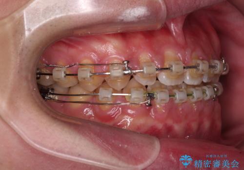 空隙歯列を閉じる 舌のトレーニングとワイヤー矯正の治療中