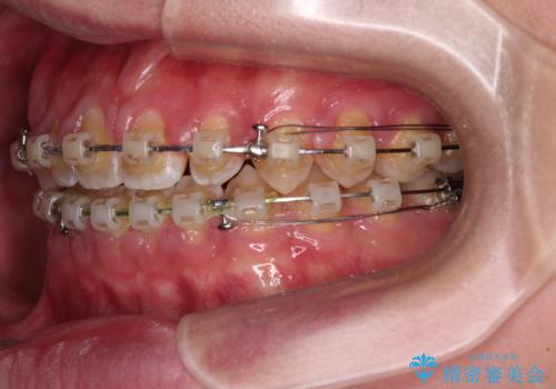 空隙歯列を閉じる 舌のトレーニングとワイヤー矯正の治療中