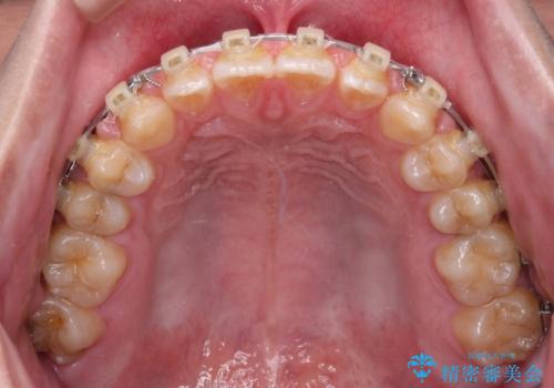 空隙歯列を閉じる 舌のトレーニングとワイヤー矯正の治療中