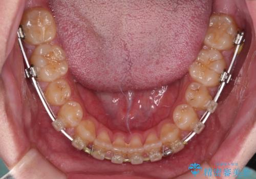 空隙歯列を閉じる　舌のトレーニングとワイヤー矯正の治療中
