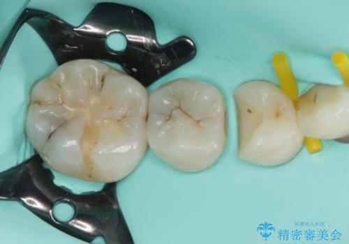 奥歯のむし歯治療 セラミックインレーの治療中