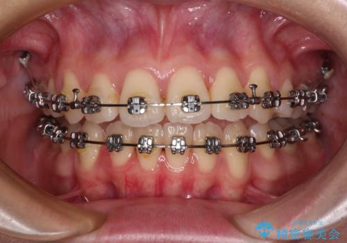 【モニター】舌のトレーニングを行いながら後戻りの再矯正の治療中