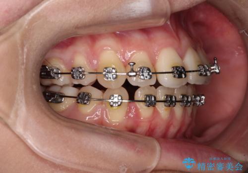 【モニター】舌のトレーニングを行いながら後戻りの再矯正の治療中