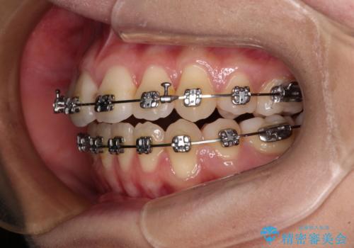 【モニター】舌のトレーニングを行いながら後戻りの再矯正の治療中