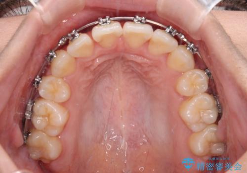 【モニター】舌のトレーニングを行いながら後戻りの再矯正の治療中
