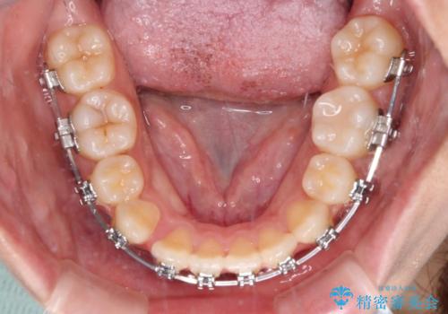 【モニター】舌のトレーニングを行いながら後戻りの再矯正の治療中