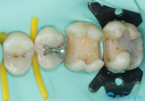 奥歯のむし歯治療 セラミックインレーの治療中