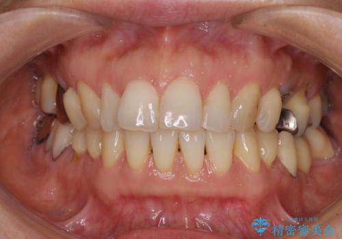 正中のズレと飛び出した前歯を改善　メタルブラケットでの抜歯矯正の症例 治療前