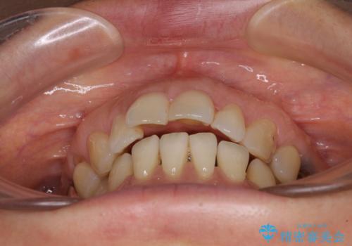 正中のズレと飛び出した前歯を改善　メタルブラケットでの抜歯矯正の治療前