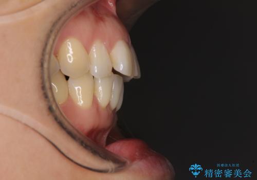 正中のズレと飛び出した前歯を改善 メタルブラケットでの抜歯矯正の治療前