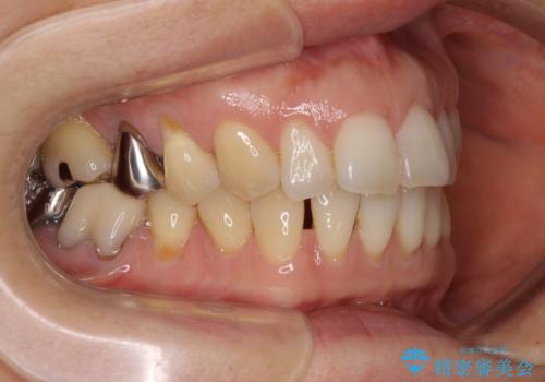 正中のズレと飛び出した前歯を改善 メタルブラケットでの抜歯矯正の治療前
