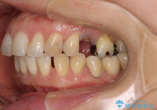 正中のズレと飛び出した前歯を改善 メタルブラケットでの抜歯矯正の治療前