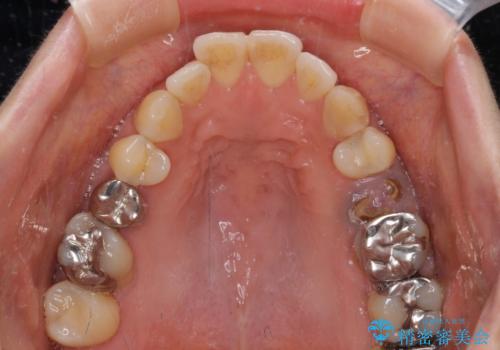 正中のズレと飛び出した前歯を改善 メタルブラケットでの抜歯矯正の治療前