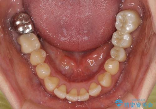 正中のズレと飛び出した前歯を改善 メタルブラケットでの抜歯矯正の治療前