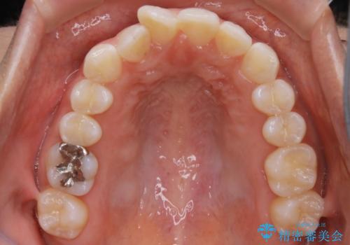 【非抜歯】下の前歯が1本少ない場合の矯正治療の治療前