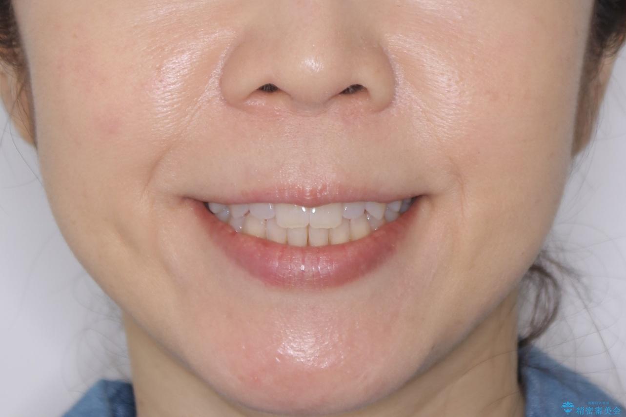 【非抜歯】短期間で実現する前歯の反対咬合治療の治療後(顔貌)