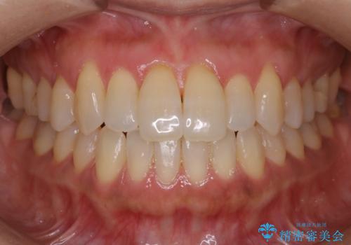 【非抜歯】短期間で実現する前歯の反対咬合治療の症例 治療後