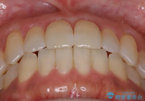 【非抜歯】短期間で実現する前歯の反対咬合治療の治療後