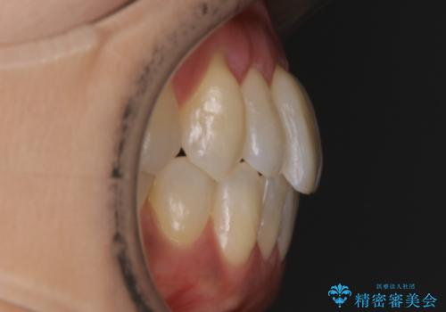 【非抜歯】短期間で実現する前歯の反対咬合治療の治療後