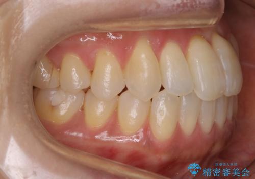 【非抜歯】短期間で実現する前歯の反対咬合治療の治療後