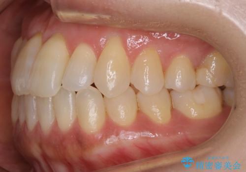 【非抜歯】短期間で実現する前歯の反対咬合治療の治療後