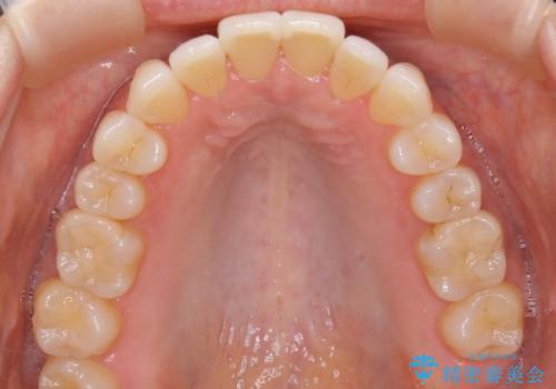 【非抜歯】短期間で実現する前歯の反対咬合治療の治療後