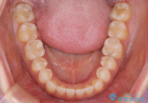【非抜歯】短期間で実現する前歯の反対咬合治療の治療後