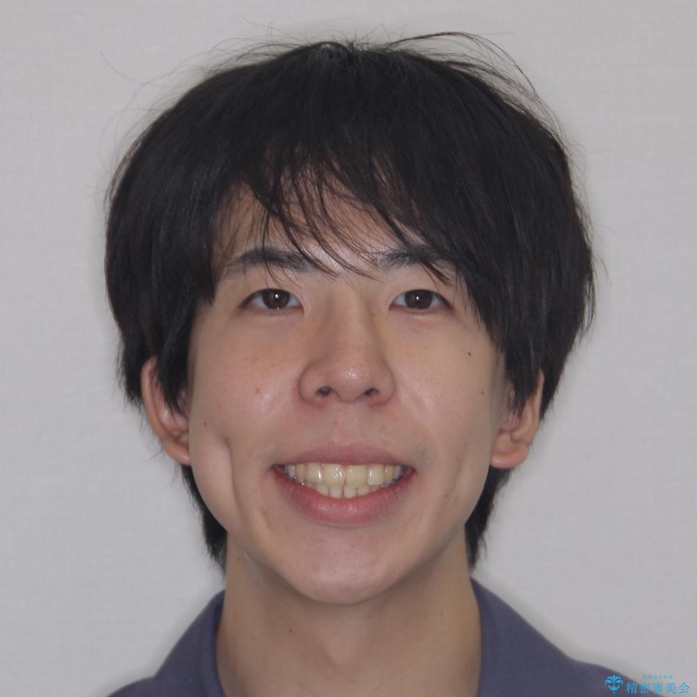 【モニター】後戻りで飛び出してきた前歯 ワイヤー装置での再矯正の治療後(顔貌)