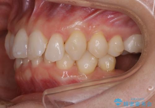 【抜歯】矯正治療とインプラントで正常な噛み合わせを実現の治療中