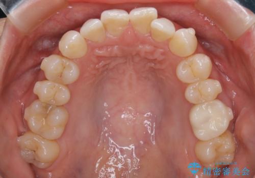 【抜歯】矯正治療とインプラントで正常な噛み合わせを実現の治療中
