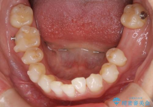 【抜歯】矯正治療とインプラントで正常な噛み合わせを実現の治療中