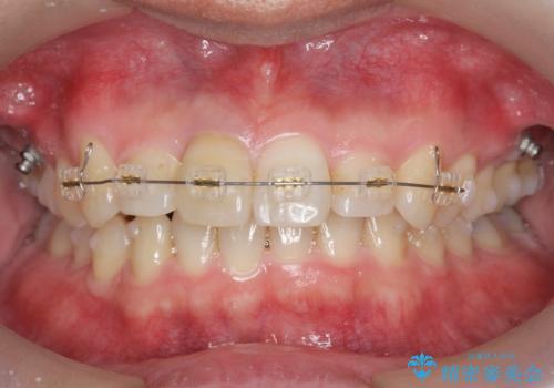 2級ディープバイト 遠心移動を伴うマウスピース矯正の治療後