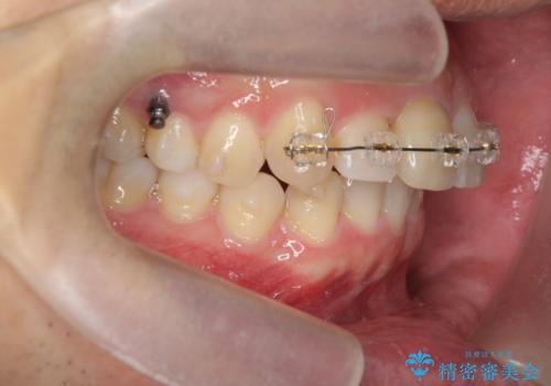 2級ディープバイト 遠心移動を伴うマウスピース矯正の治療後