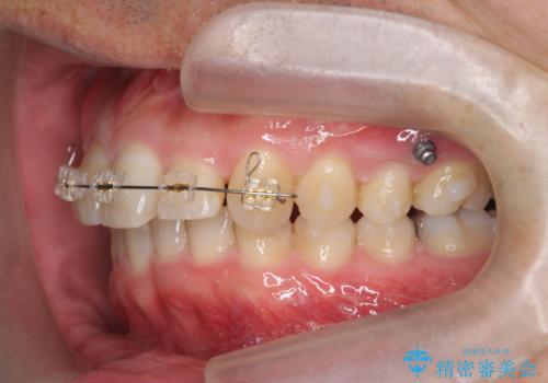 2級ディープバイト 遠心移動を伴うマウスピース矯正の治療後