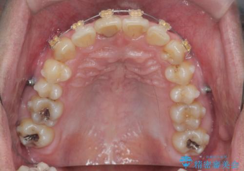 2級ディープバイト 遠心移動を伴うマウスピース矯正の治療後