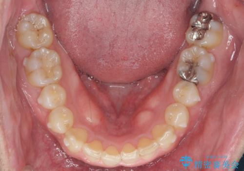 2級ディープバイト 遠心移動を伴うマウスピース矯正の治療後