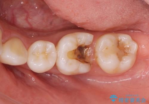 メタルの詰め物が取れたの症例 治療前