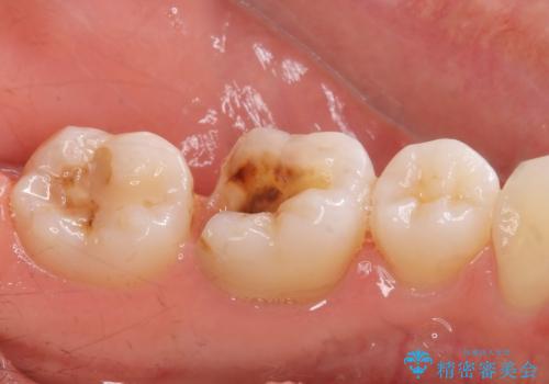 メタルの詰め物が取れたの治療前