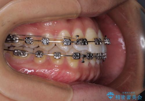 【モニター】楽して治したい メタルブラケットによる矯正治療の治療中