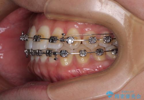 【モニター】楽して治したい メタルブラケットによる矯正治療の治療中