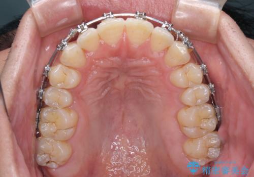 【モニター】楽して治したい メタルブラケットによる矯正治療の治療中