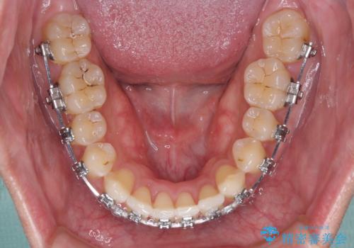 【モニター】楽して治したい メタルブラケットによる矯正治療の治療中