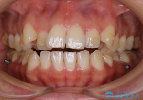 【非抜歯】20代女性　歯のガタつきと噛み合わせの治療の症例 治療前