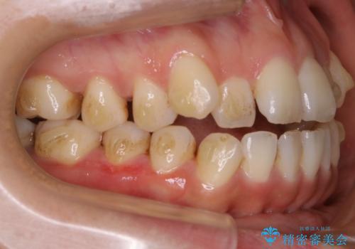 【非抜歯】20代女性　歯のガタつきと噛み合わせの治療の治療中